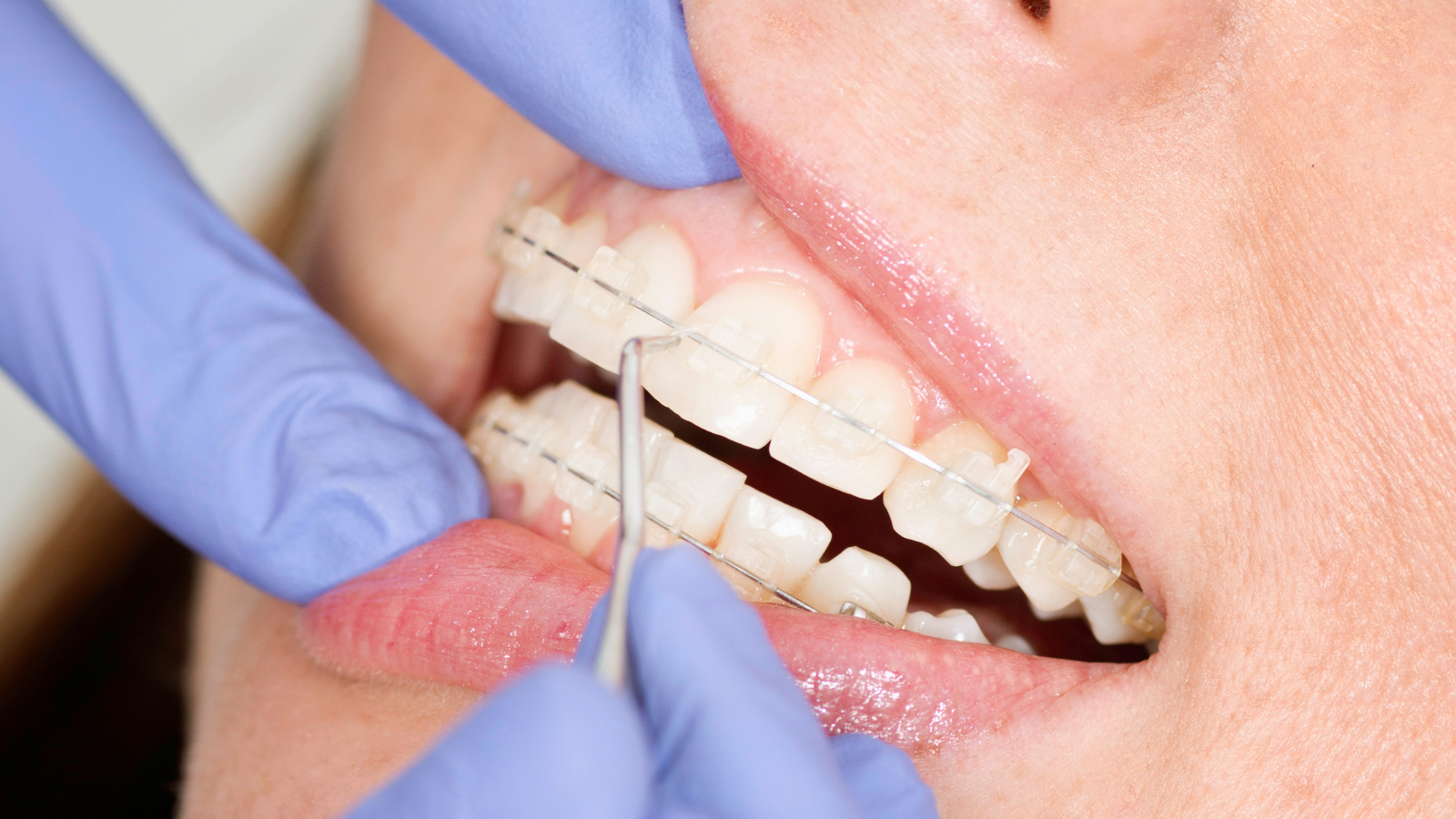 Pacient cu aparat dentar în timpul unui consult ortodontic