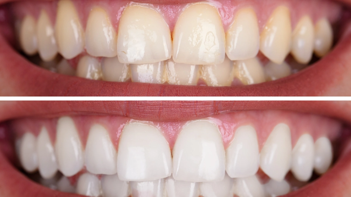 albire dentara Vaslui Elite BioDental