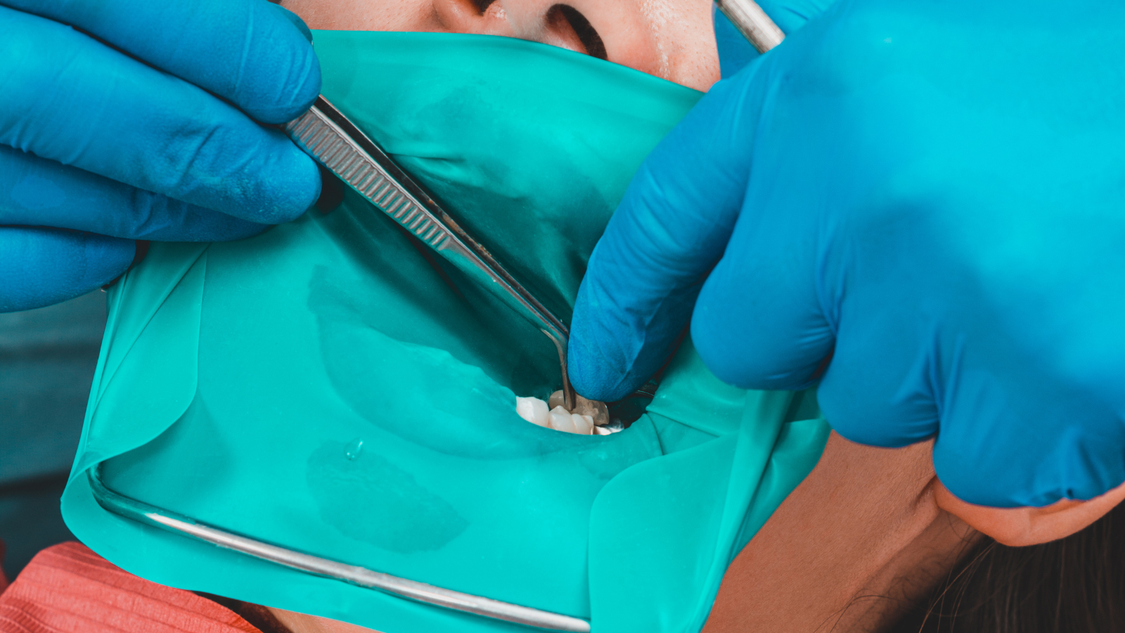 Tratament endodontic – intervenție canal dentar