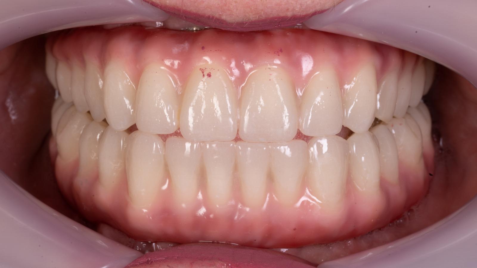Rezultat implant dentar All-on-6 în Vaslui