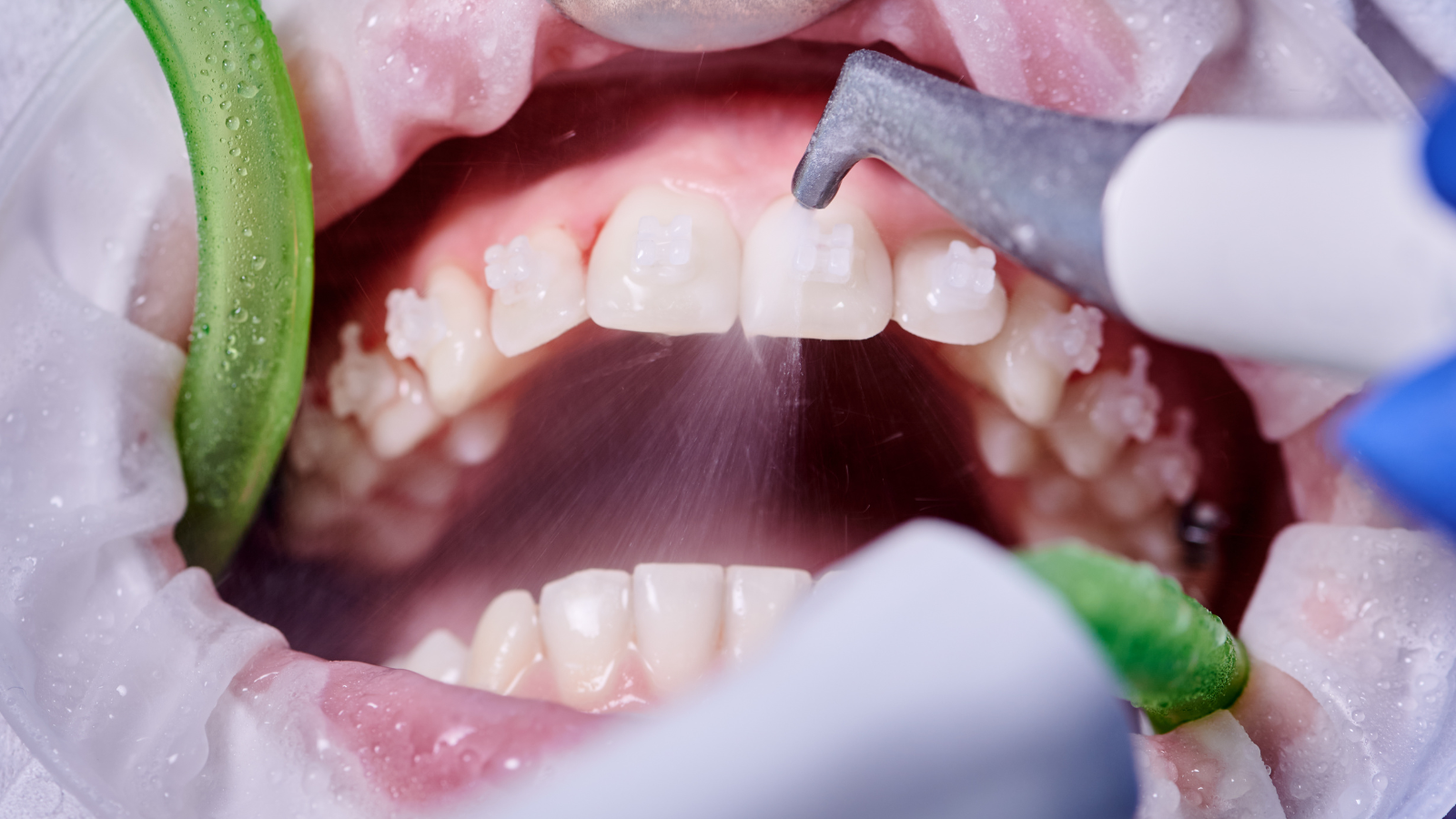 Profilaxie dentară – igienizare profesională